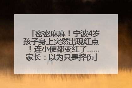 密密麻麻！宁波4岁孩子身上突然出现红点！连小便都变红了……家长：以为只是摔伤